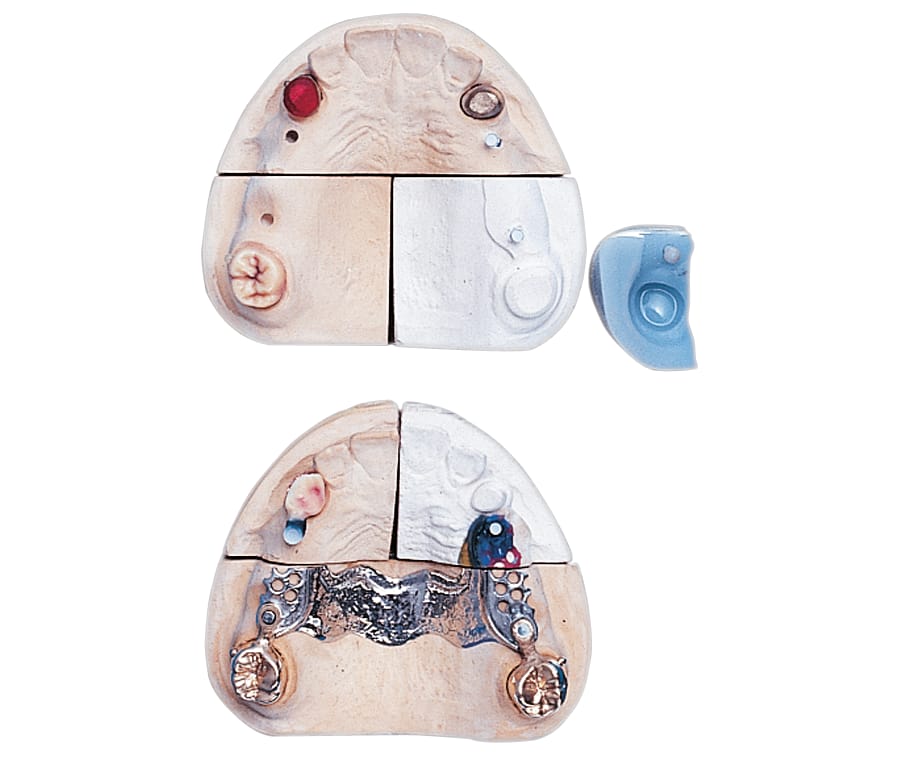 Paracon – Servo-Dental, Geschiebe