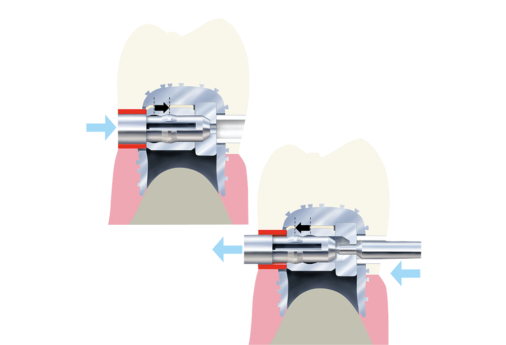 Snap-Slot latch – Servo-Dental, Geschiebe