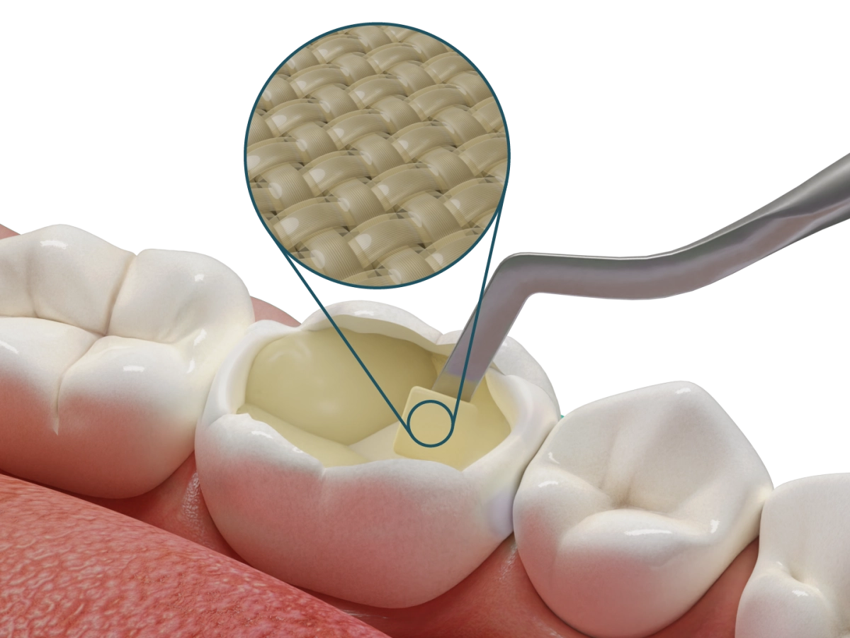 Fibrafill® CUBE – ADM Dental (Dentapreg & Fibrafill), Composites