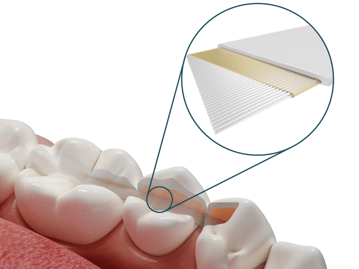 Dentapreg® SFU – ADM Dentapreg & Fibrafill, Sonstige Schienen