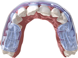 Aqualizer® Dental Splints – Aqualizer Splints by Jumar Corporation, Sonstige Schienen