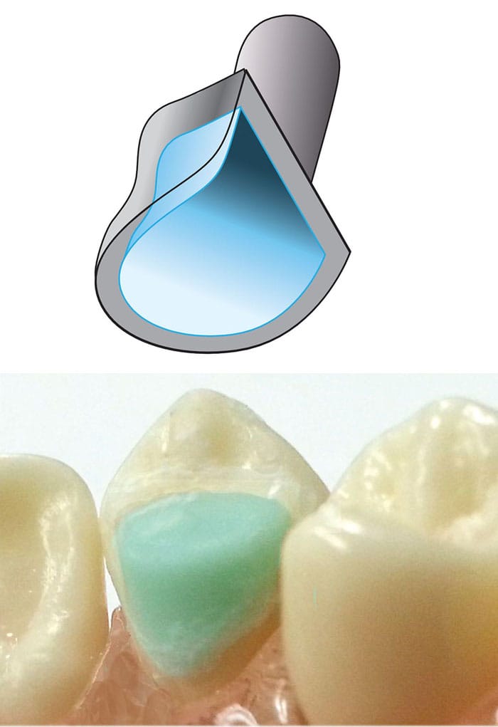 DYNAFLEX CUSPID BITE RAMP 2045-25 – Dynaflex Orthodontics USA, Sonstige Schienen