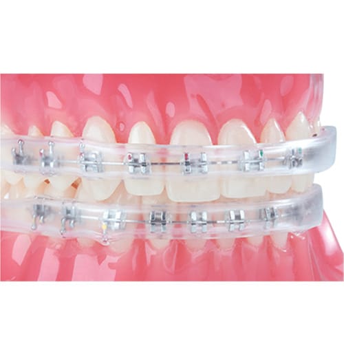 COMFORT COVERS FOR ORTHODONTIC BRACES O-100-1088