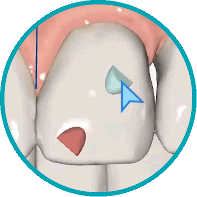 SmileShare™ Clear Aligners