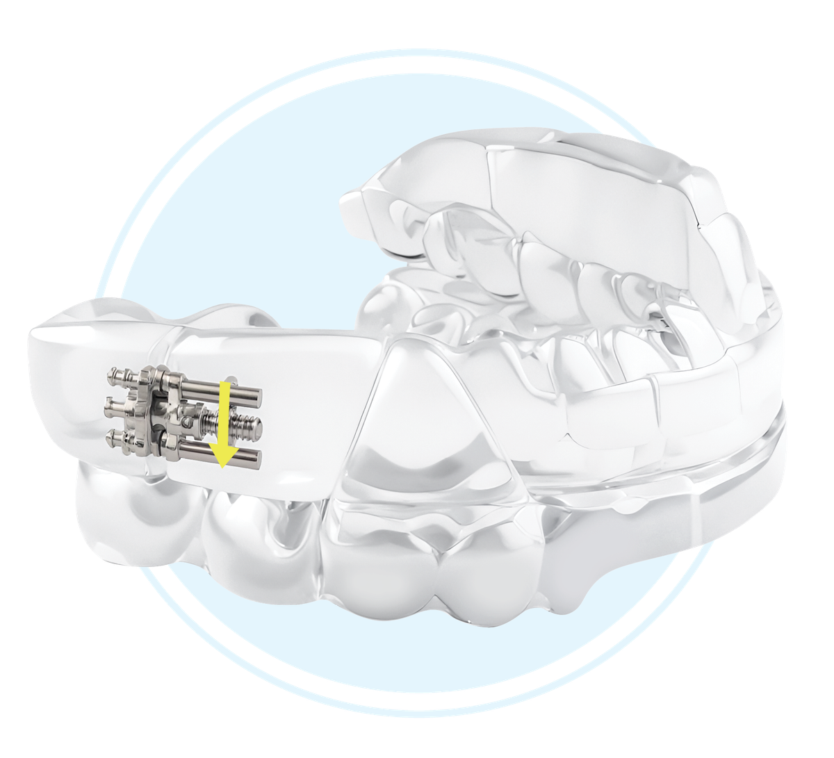 DynaFlex Dorsal – Dynaflex Orthodontics USA, Sonstige Schienen