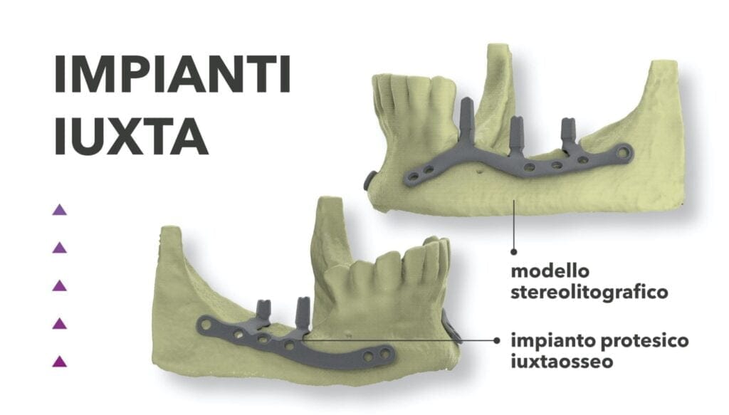 Impianti IUXTA Subperiostali – B&B Dental SRL, Implantate