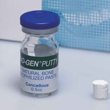 Biomateriali per rigenerazione ossea – Putty – BIOACTIVA Srl, Knochenersatzmaterial