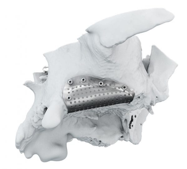 Griglia 3D – BIOACTIVA Srl, Implantologie