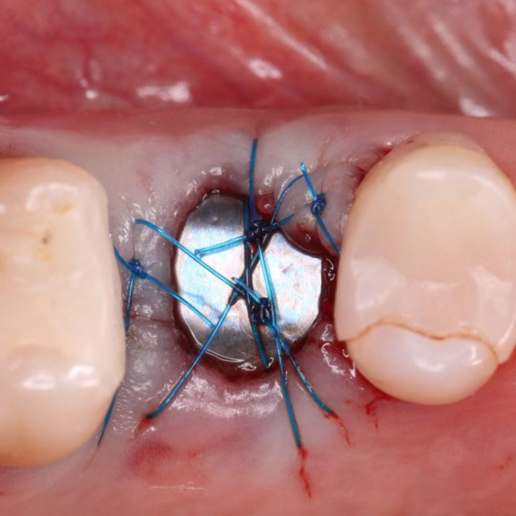 Surgitime Titanium Seal – Bionnovation Biomedical, Implantologie