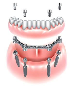 Dispositivo CAB – Clip-Abutment-Bar