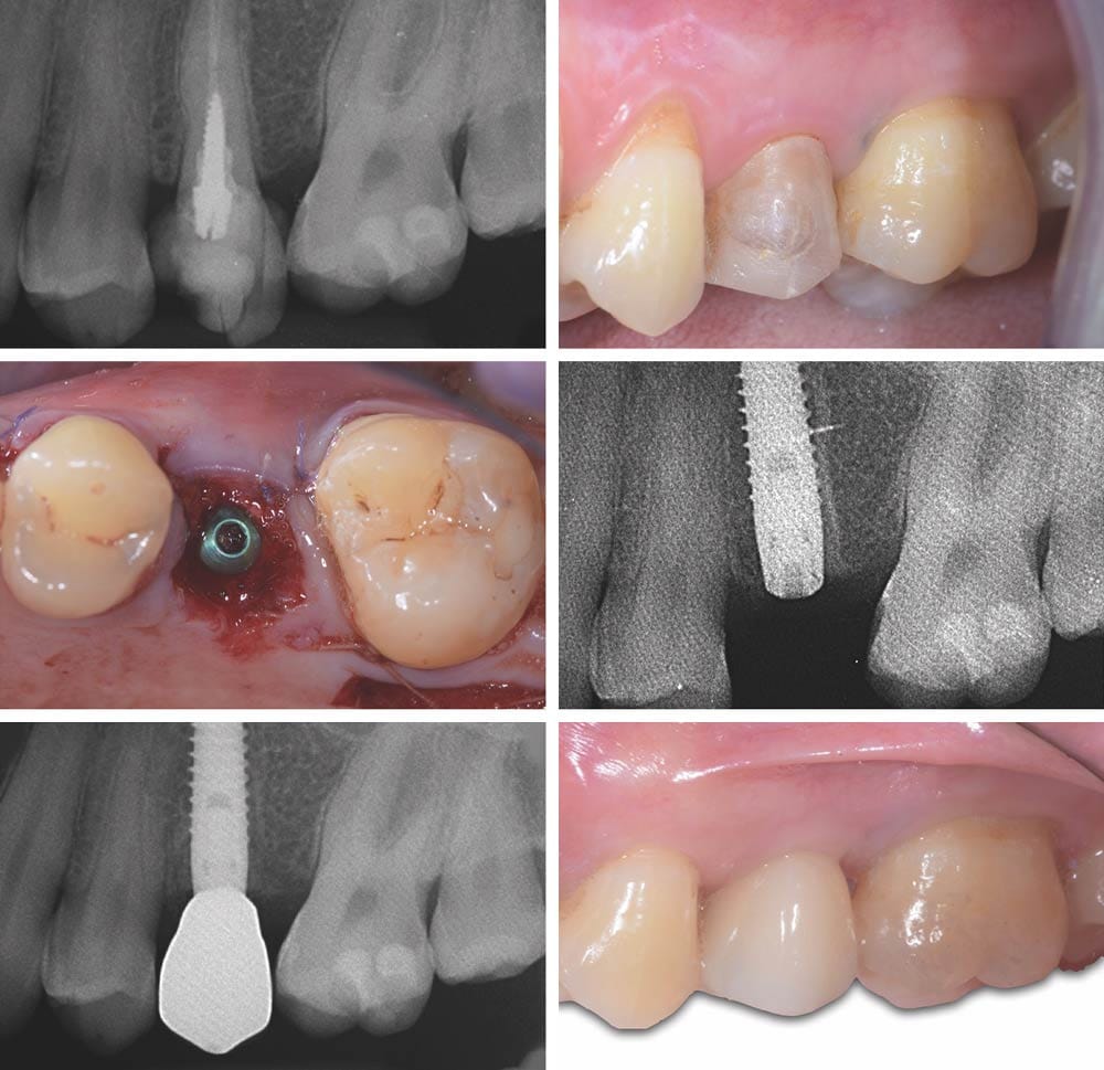 Implantate Linea KAPPA – BioSAF IN, Implantate