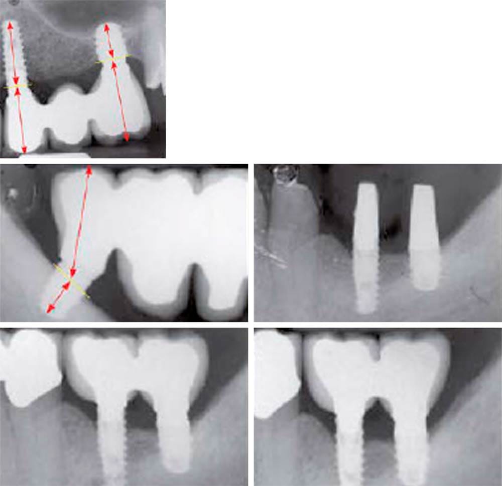 SHORT Implants – BioSAF IN, Implantate
