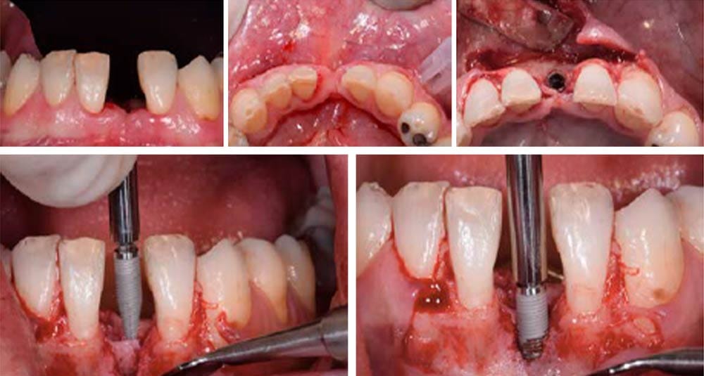 SLIM Implants – BioSAF IN, Implantate