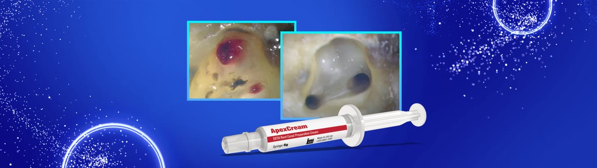 DSI ApexCream Root Canal Prep – DSI Dental Solutions Ltd, Wurzelbehandlung