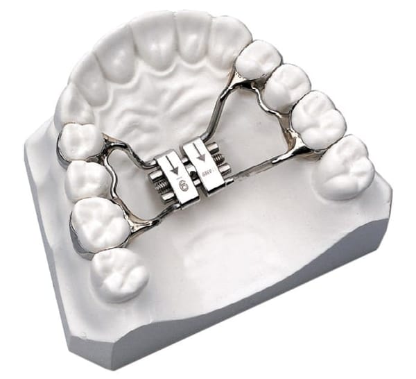 Vorgebogener Rapid-Palatal-Expander (RPE)