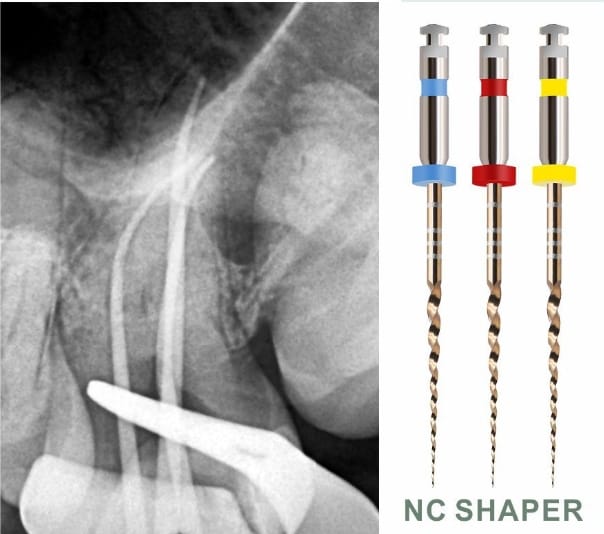 NC SHAPER S1 – Shenzhen Denco Medical Co., Ltd, Wurzelbehandlung