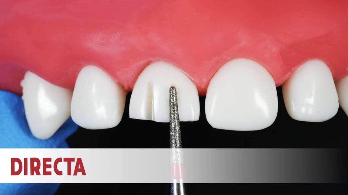 Ceramir Pediatric Crowns Kit – Directa Dental Group, Provisorische Kronen