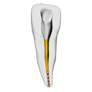 Incisor – Gutta percha, Broken file, Clear