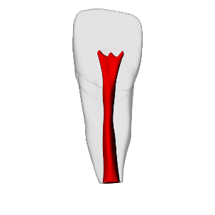 Incisor – Open apex, Pulp