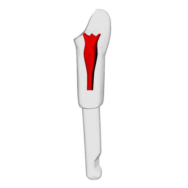 Incisor – Open apex, Pulp exposure, Kavo