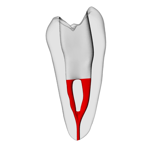 Premolar – Accessed, Merging canals, Radiopaque (White)