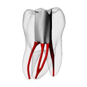 Molar – Accessed, Merging MB2, Clear, ~20# – DRSK Group AB, Demomodelle