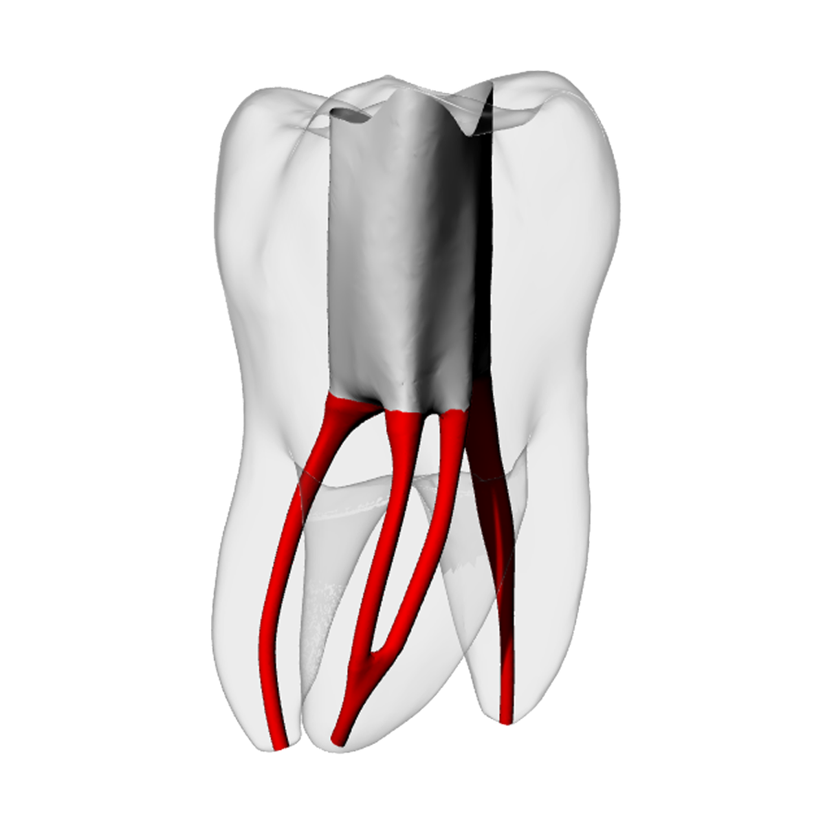 Molar – Accessed, Merging MB2, Radiopaque (White) – DRSK Group AB, Demomodelle
