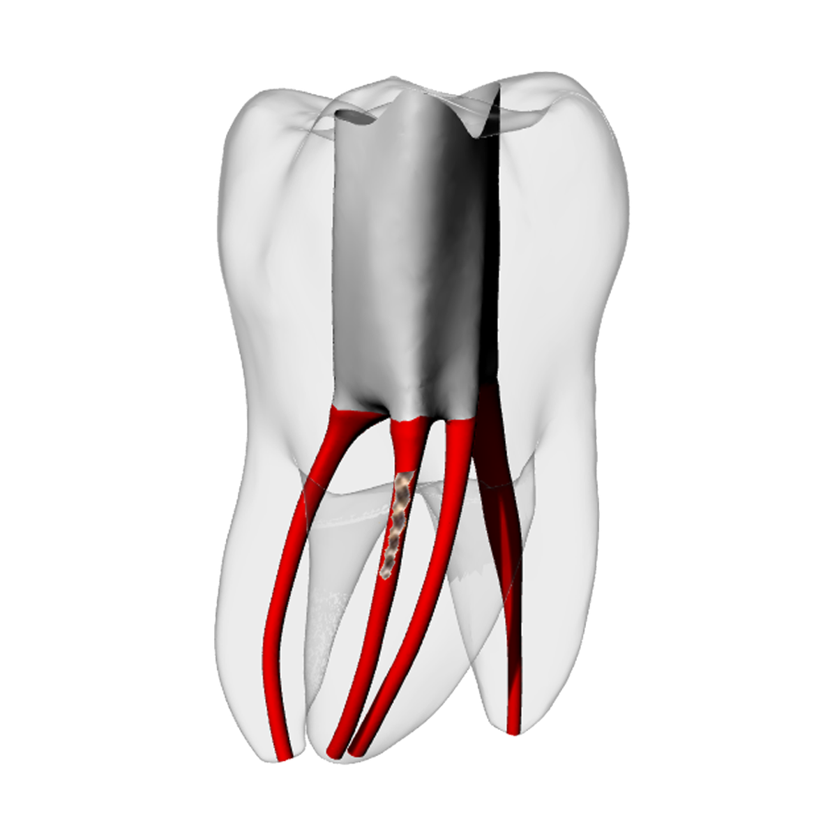Molar – Broken file – DRSK Group AB, Zubehör für Wurzelbehandlung