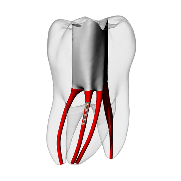Molar – Broken file
