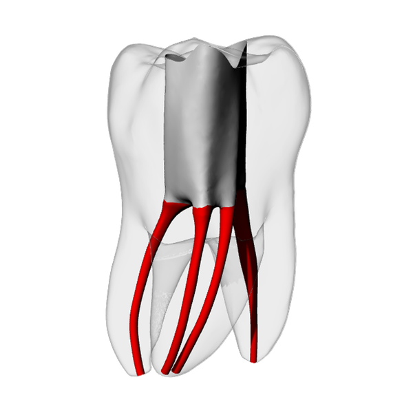 Molar – Accessed, MB2, Radiopaque (White)