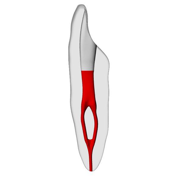 Incisor – Merging canal, Radiopaque (White)