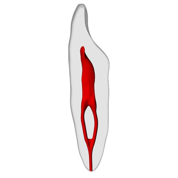 Incisor – Merging canal, Clear Root, White Crown, ~20#