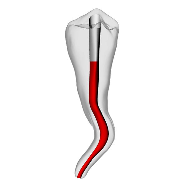 Premolar – Accessed, Dilacerated, Radiopaque (White)
