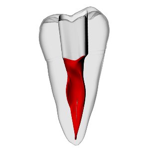 Second molar – C-Shape – DRSK Group AB, Zubehör für Wurzelbehandlung