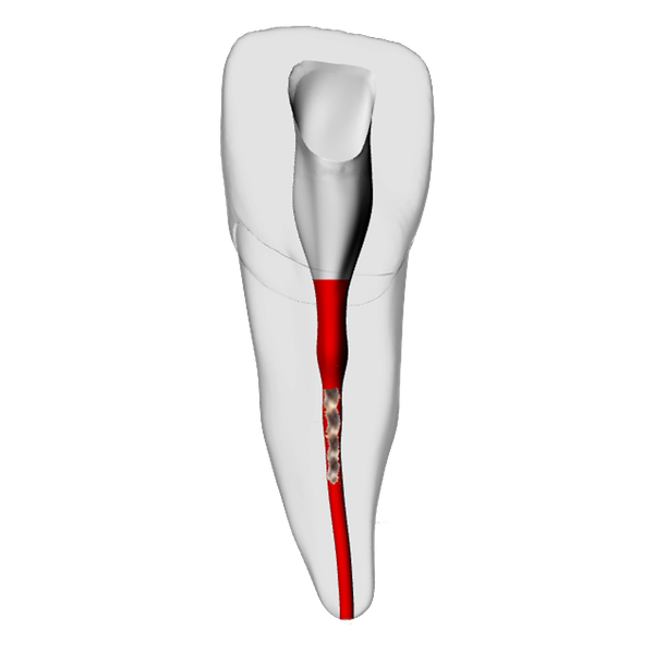 Incisor – Broken file