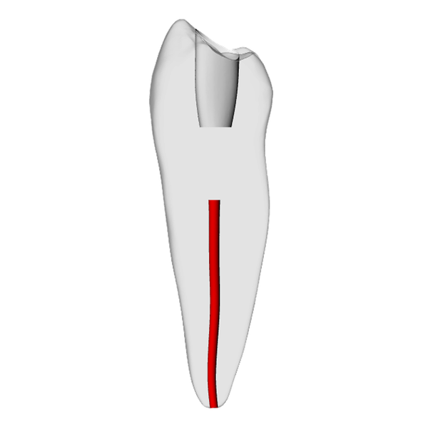 Premolar – Obliterated, Radiopaque (White)