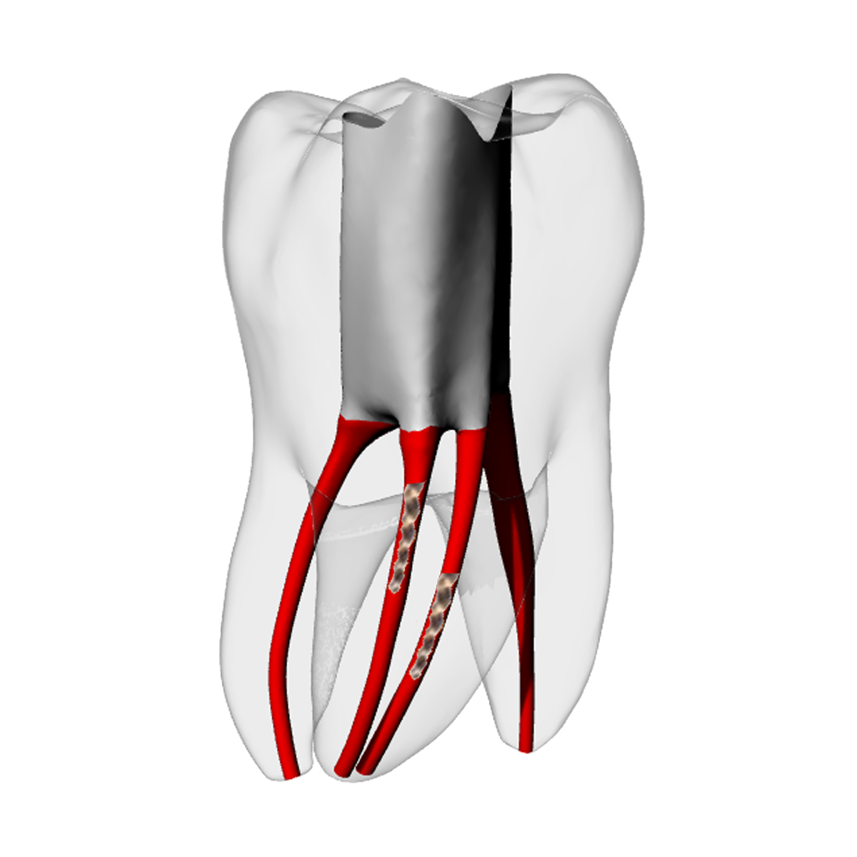 Molar – Two Broken files – DRSK Group AB, Zubehör für Wurzelbehandlung