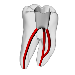 Molar – Accessed, Merging canals, Clear – DRSK Group AB, Demomodelle