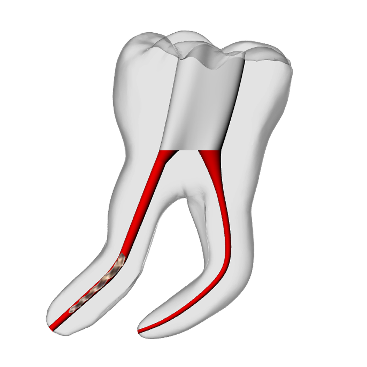 Molar – 6mm Broken File, 30° Distal Canal – DRSK Group AB, Zubehör für Wurzelbehandlung