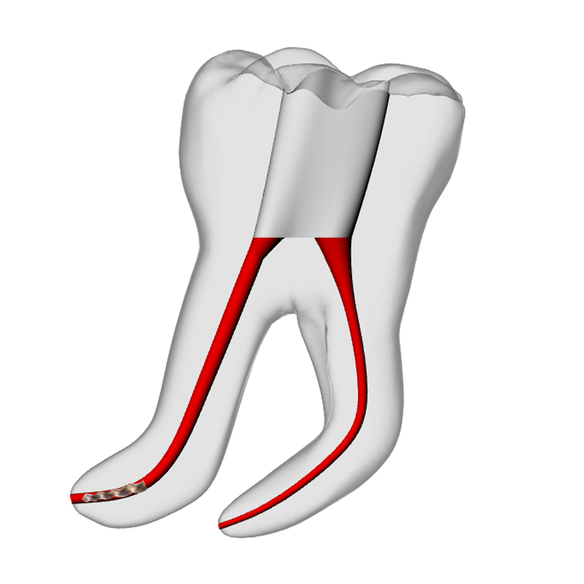 Molar – 3mm Broken File, 60° Distal Canal – DRSK Group AB, Zubehör für Wurzelbehandlung