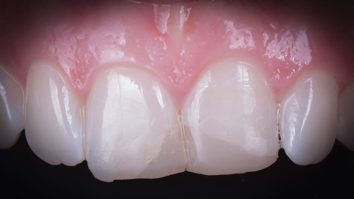 SEALTEMP S Clear – ELSODENT SAS, Zemente