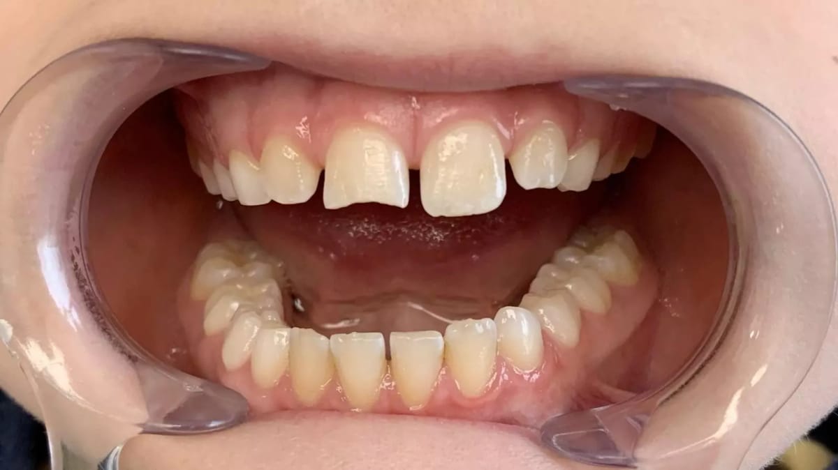 PURESHADE Shade 1 – ELSODENT SAS, Composites