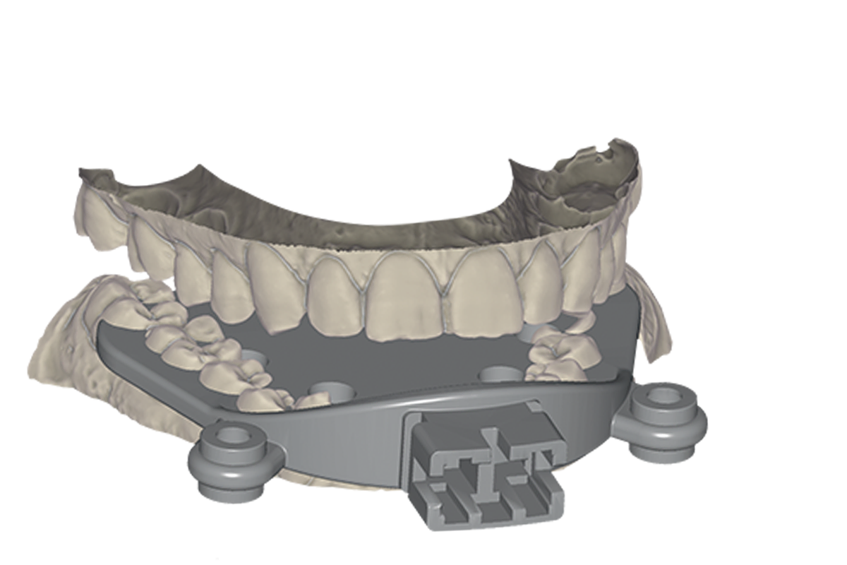 Jaw Motion Import Module – Exocad, CAD/CAM-Software