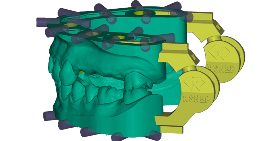 xSNAP Module – Exocad, CAD/CAM-Software