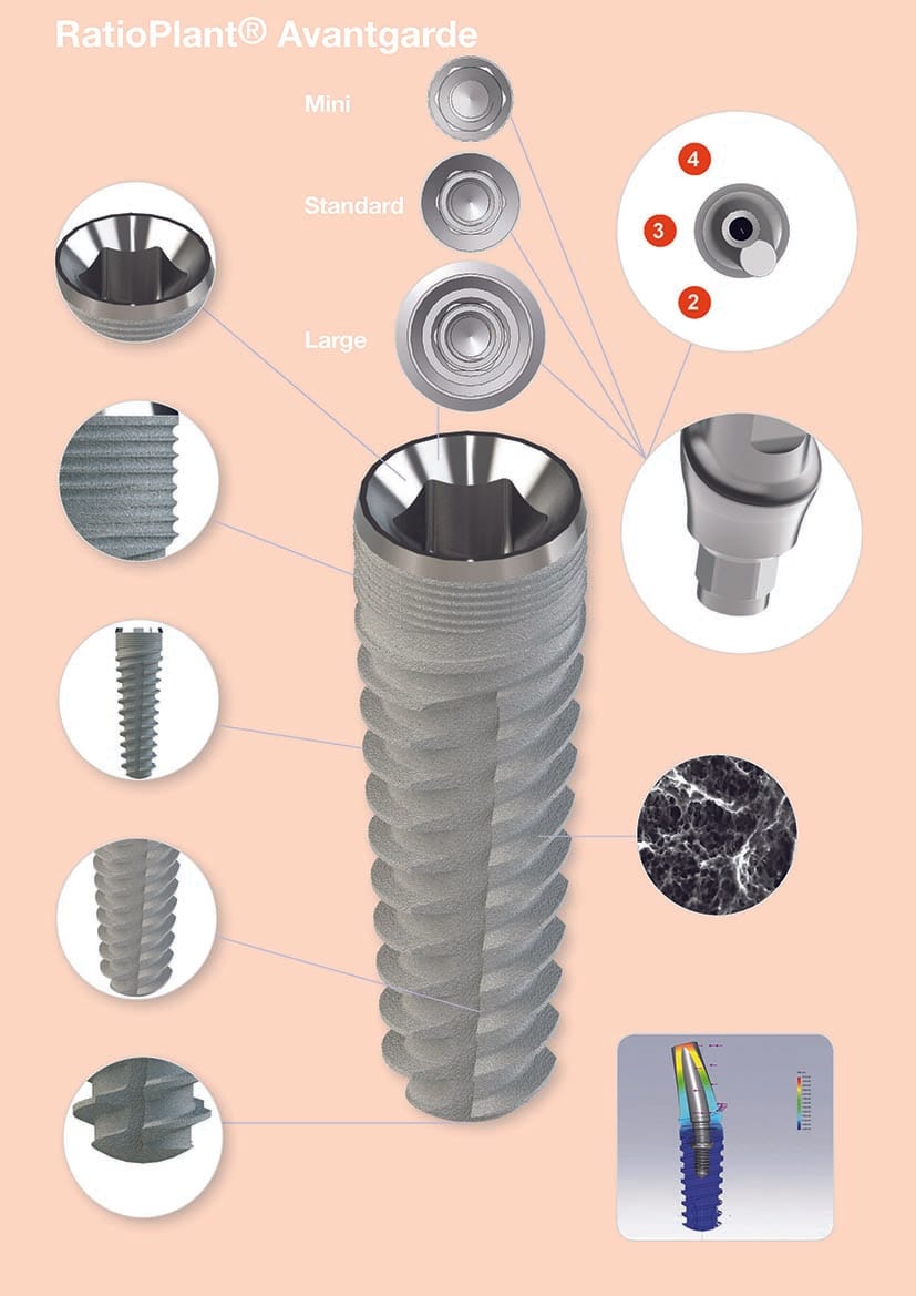 RatioPlant® Avantgarde – HumanTech Dental GmbH, Implantate