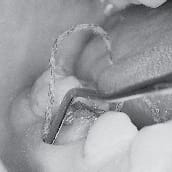 1 Yardley Gingivafadenträger (#41) – Hu-Friedy Mfg., Interdentalkeile