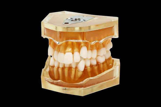 Dentalmodell für Zahnextraktionen – Navadha Enterprises, Gipszusätze, Stumpflacke und Gipslöser