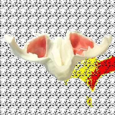 Anatomisches Kiefermodell in Originalgröße mit Sinus für Zygomatikum-Implantate – Navadha Enterprises, Implantologie