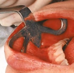 MATY Retractor Children