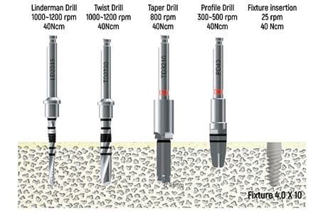 Implant System - MT-Act Fixture and Mini System